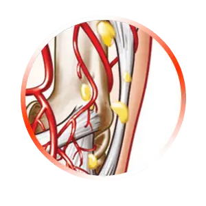 BREAK UP TENDON CALCIFICATION