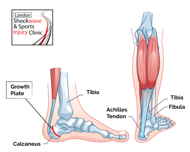 Severs Disease anatomy heel pain treatment solutions speed up healing shock wave London wimbledon