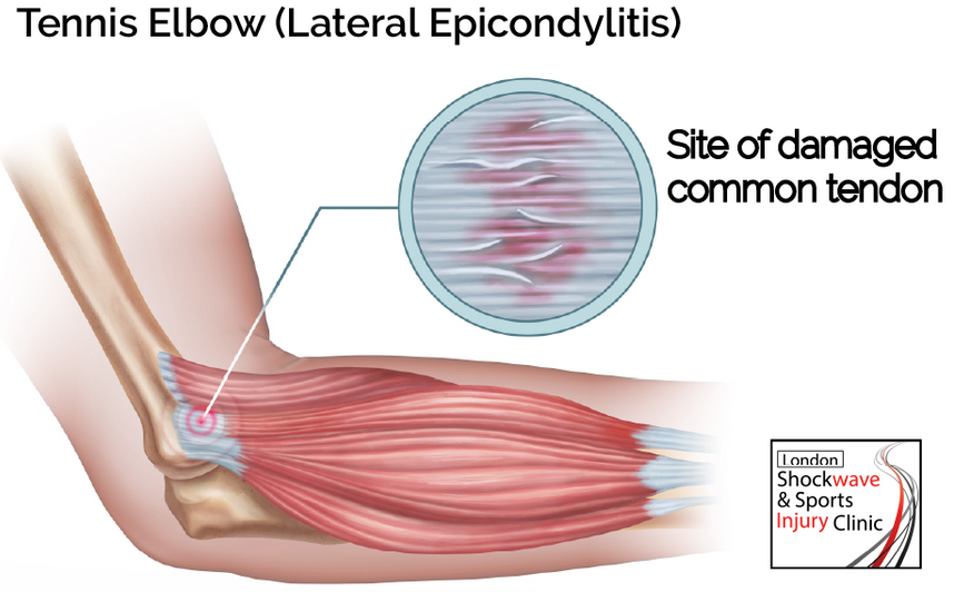 The procedure involves applying a hand-held device that emits shock waves to the affected area.