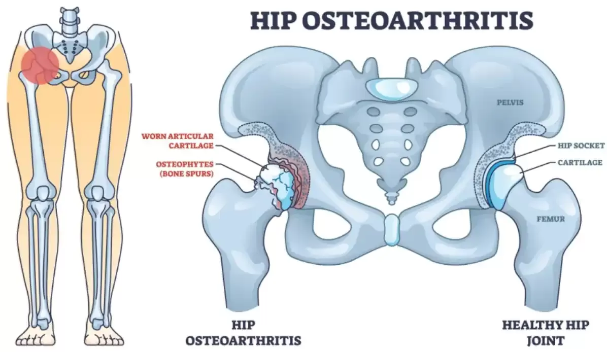 Shockwave Therapy for Hip Osteoarthritis